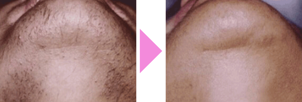 Before After